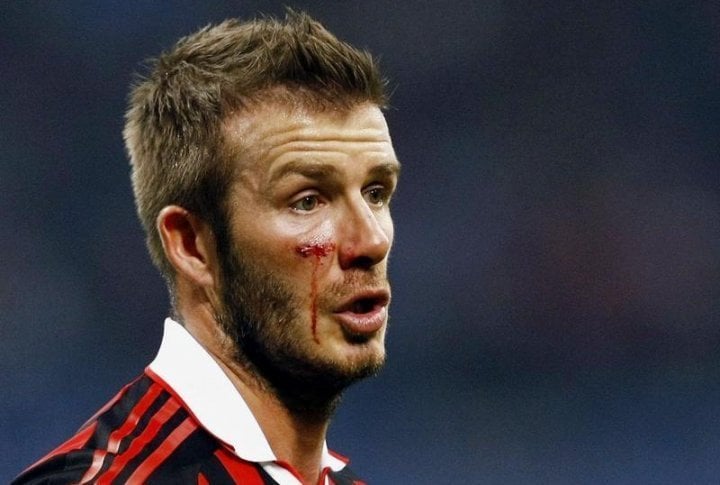 David Beckham bleeds from his cheek as he looks on during the Italian series soccer match against Chievo in Milan. ©REUTERS/Alessandro Garofalo