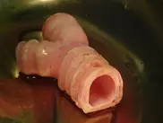 Шведы впервые в мире пересадили синтетическую трахею