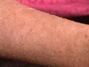 У 28-летней американки вместо волос растут ногти