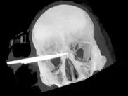 Новозеландец выжил после ранения в голову 9-сантиметровым ножом