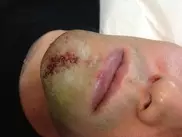 Овечкину пришлось наложить 22 шва