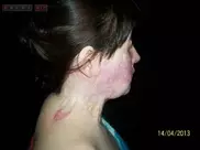 В Алматы пациентке пересадили лицо