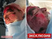 СМИ опубликовали фотографии с операций на лице балетмейстера из России 