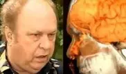 Американец полтора года страдал "утечкой мозга"