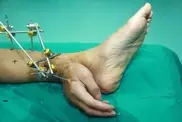 Китайские врачи пришили оторванную руку к ноге