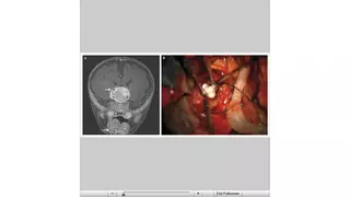 В мозгу ребенка выросли несколько зубов
