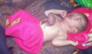 В Индии родился ребенок с сердцем снаружи