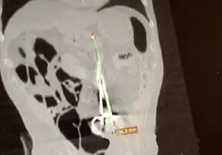 Карагандинец 12 лет ходил с хирургическим зажимом в животе