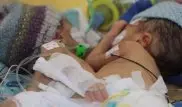 Швейцарские врачи успешно разделили восьмидневных сиамских близнецов