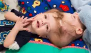 В США хирурги успешно разделили годовалых сиамских близнецов