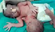 Девочка родилась со второй головой на животе