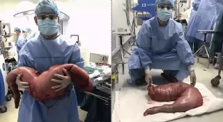 Китайские врачи удалили из живота пациента гигантскую аномалию