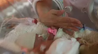 В Индии скончался ребёнок-мутант, которого прозвали "чужим"