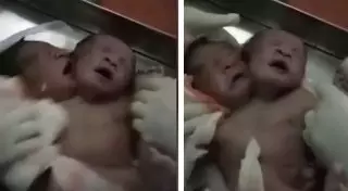 Одно тело на двоих: в Индии родились редчайшие сиамские близнецы