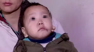 В Шымкенте мальчик родился с ухом на лице: ему нужна операция