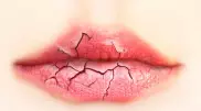 Специалисты назвали причины сухости губ