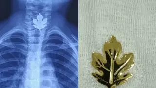 Монеты, булавки, батарейки: что кызылординские врачи извлекают из детских кишечников