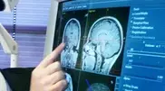 Kazakhstan doctors invented new method for brain tumor treatment