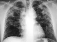 Silicosis suit could crush S.Africa's gold mining sector 