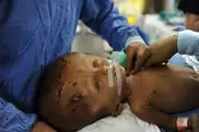 Indian doctors discharge baby with swollen head 