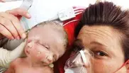 Rare Australian conjoined twins die