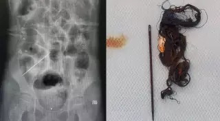 Ақтауда 14 жастағы қыздың ішегінен шаш пен ине табылды