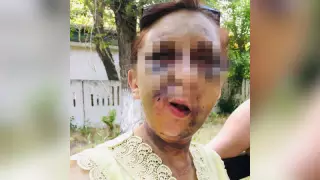 Жағы мен қабырғасы сынған: шымкенттік әйел оңбай соққыға жығылған