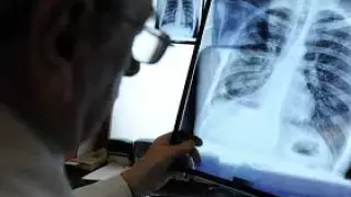 Павлодар облысында шілдеде 314 адам пневмониядан қайтыс болған