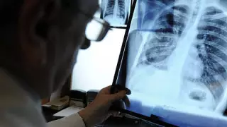 Қазақстанда 159 адамнан коронавирус белгісі бар пневмония анықталды