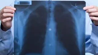 COVID-19 белгілері бар пневмонияның өңірлер бойынша статистикасы жарияланды