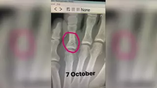 Хабиб Гэтжимен жекпе-жегінің алдында алған жарақатын көрсетті