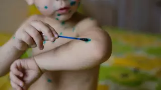 Жыл басынан бері 1200-ден аса бала қызылша ауруымен ауырды