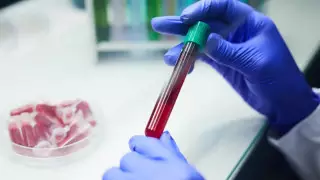 Шымкентте тұрғын Конго-Қырым геморрагиялық қызбасын жұқтырған болуы мүмкін