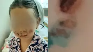 "Пластикалық ота қажет". Туыстары алабай талаған жеті жасар қыздың жағдайын айтты