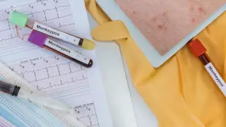 Қазақстанда маймыл шешегін емдеу хаттамасы дайындалып жатыр