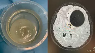 Дәрігерлер миынан алып құрт шыққан 20 жастағы қыз ауруханадан шықты