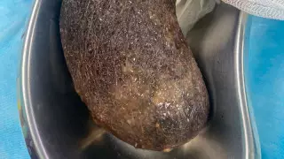 Алматыда 11 жастағы қыздың асқазанынан бір келі шаш алынды