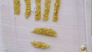 Алматыда хирургтар 62 жастағы әйелдің өтінен 1730 тас алды