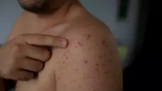 Алматыда қызылша ауруы өршіді: стационарлар 90 пайызға толған