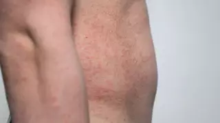 СҚО-да Ұлттық ұлан академиясының курсанттары жаппай қызылша жұқтырды