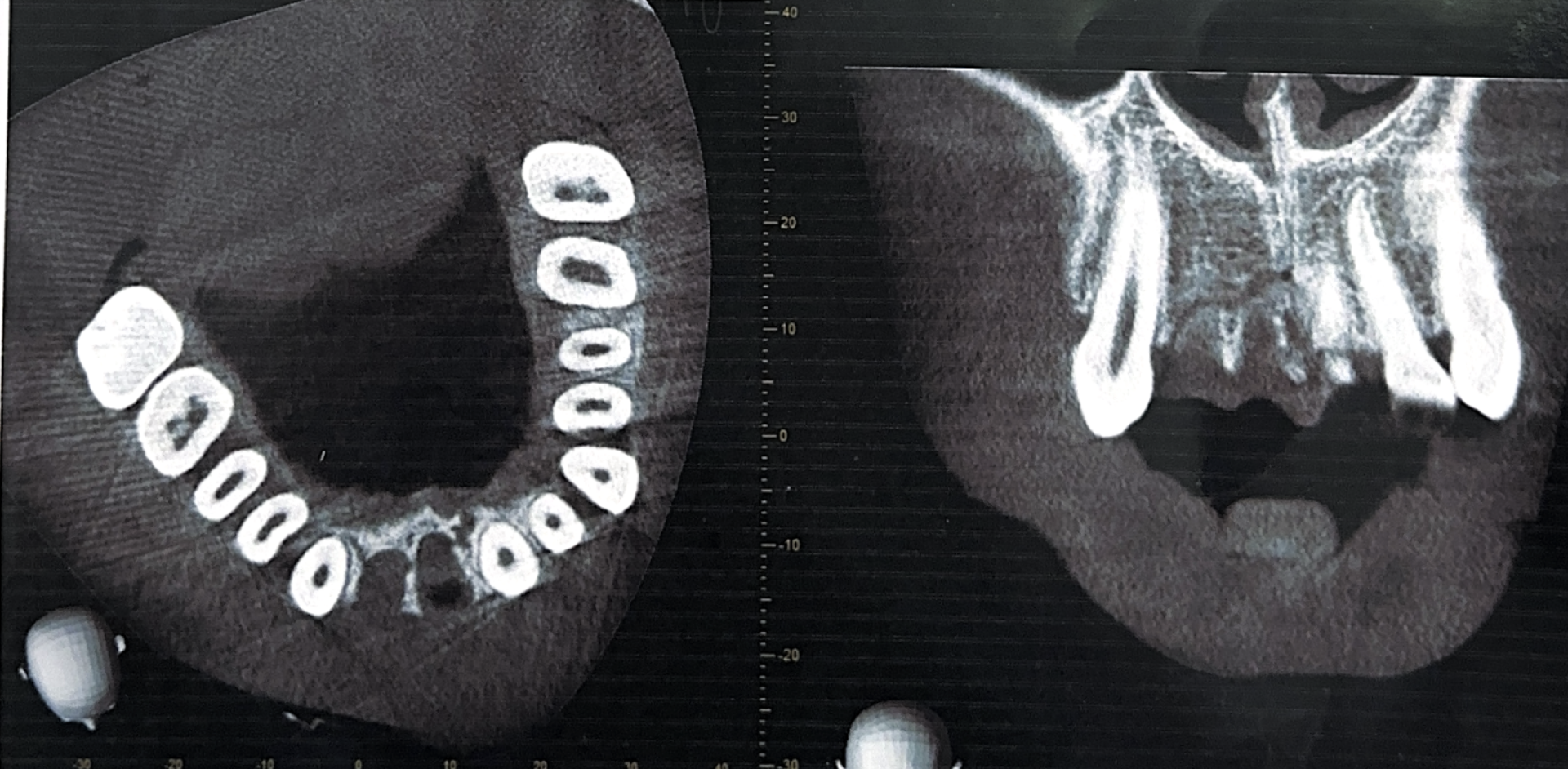 снимок зубов